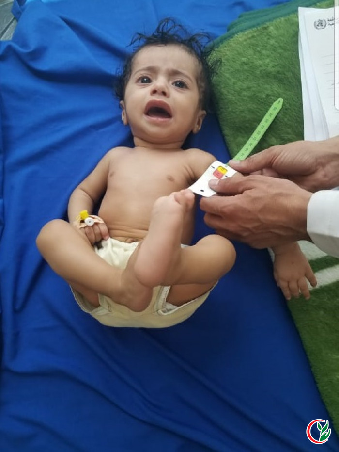 The child Ramzi Fadel, a new story for our nutritional project in the treatment of malnutrition